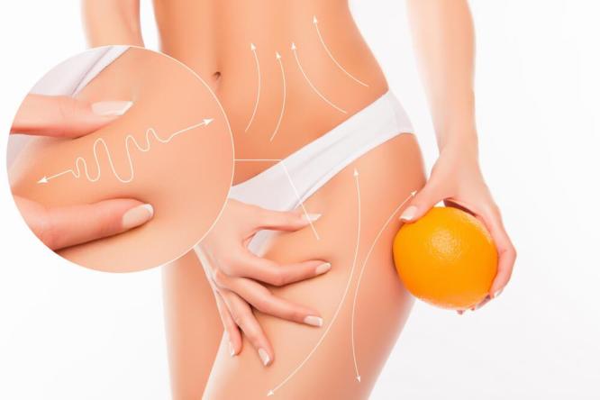 Uporczywy cellulit - skuteczna walka z pomarańczową skórką